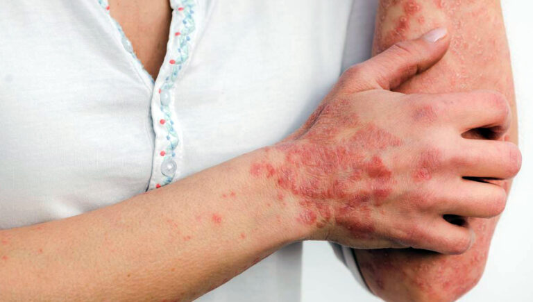 Asl Frosinone – Attivato l’ambulatorio per la diagnosi e la cura della psoriasi