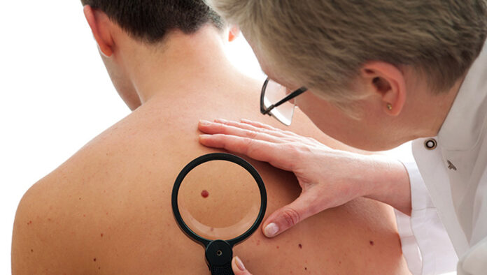 PREVENZIONE DEL MELANOMA - SITO