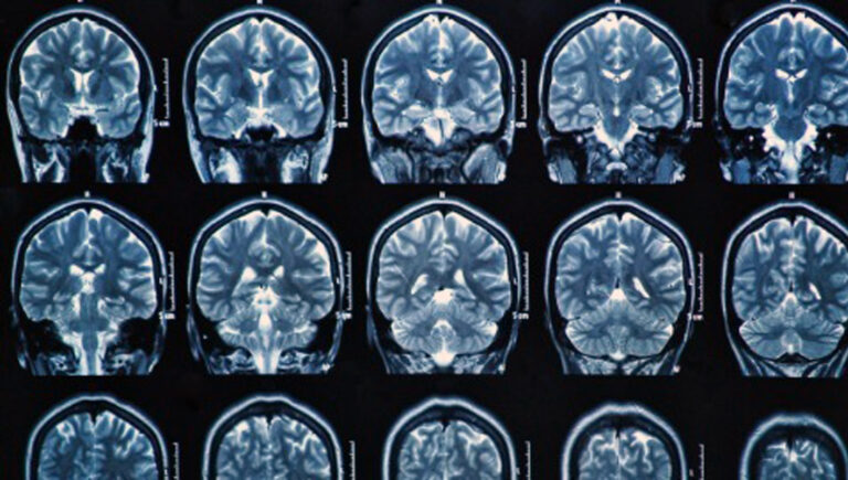 La Asl di Frosinone all’avanguardia per il trattamento delle metastasi cerebrali