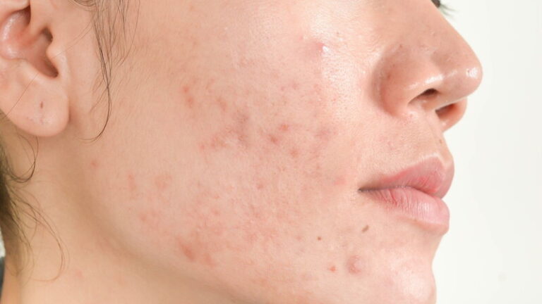 pelle viso impura