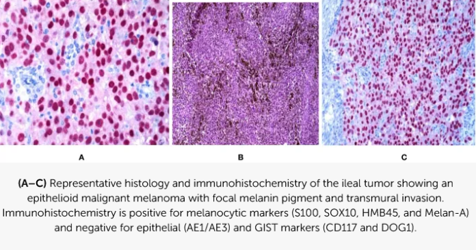 Representative histology and immunohistochemistry of the ileal tumor